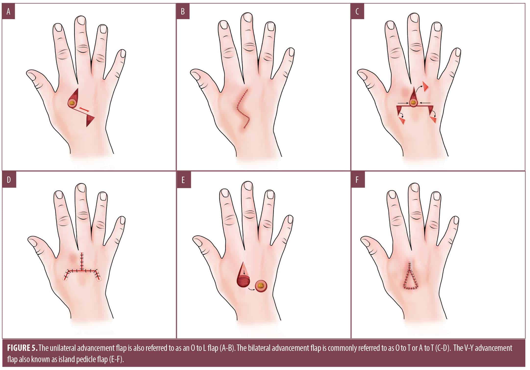 Review of Cutaneous Repairs on the Hand and Fingers Following