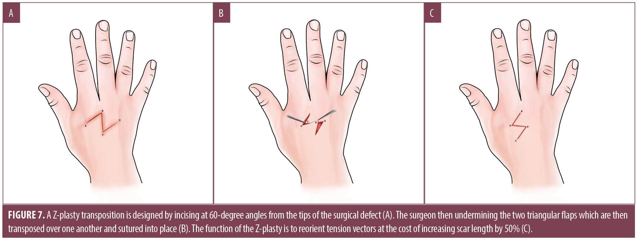 Review of Cutaneous Repairs on the Hand and Fingers Following