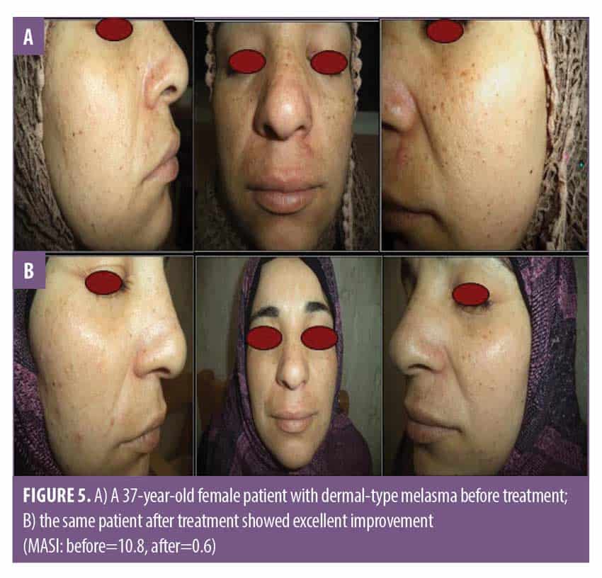 Treatment of Melasma with Intralesional Tranexamic Acid Versus Cryotherapy JCAD The Journal
