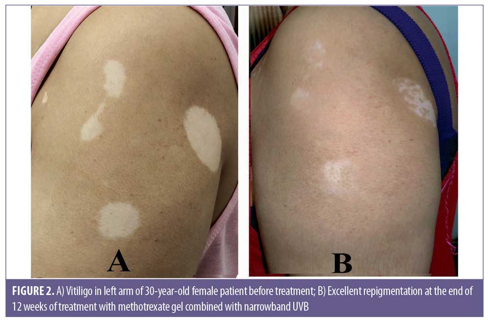 Narrow Band Uvb Light Treatment Vitiligo Shelly Lighting