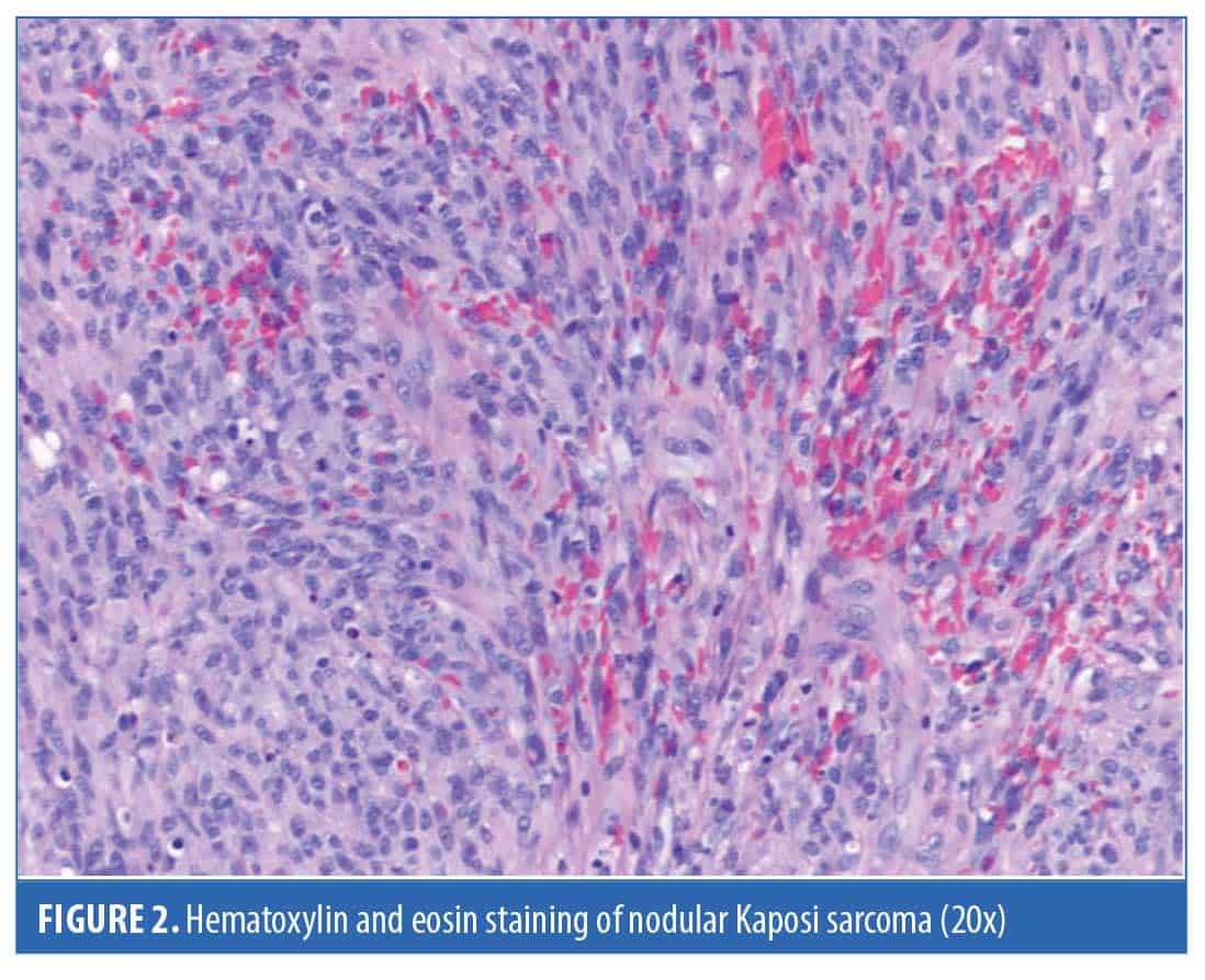 Kaposi of the Face Not Associated with Acquired