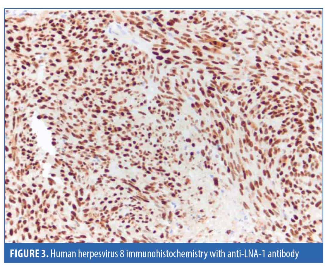 Kaposi of the Face Not Associated with Acquired