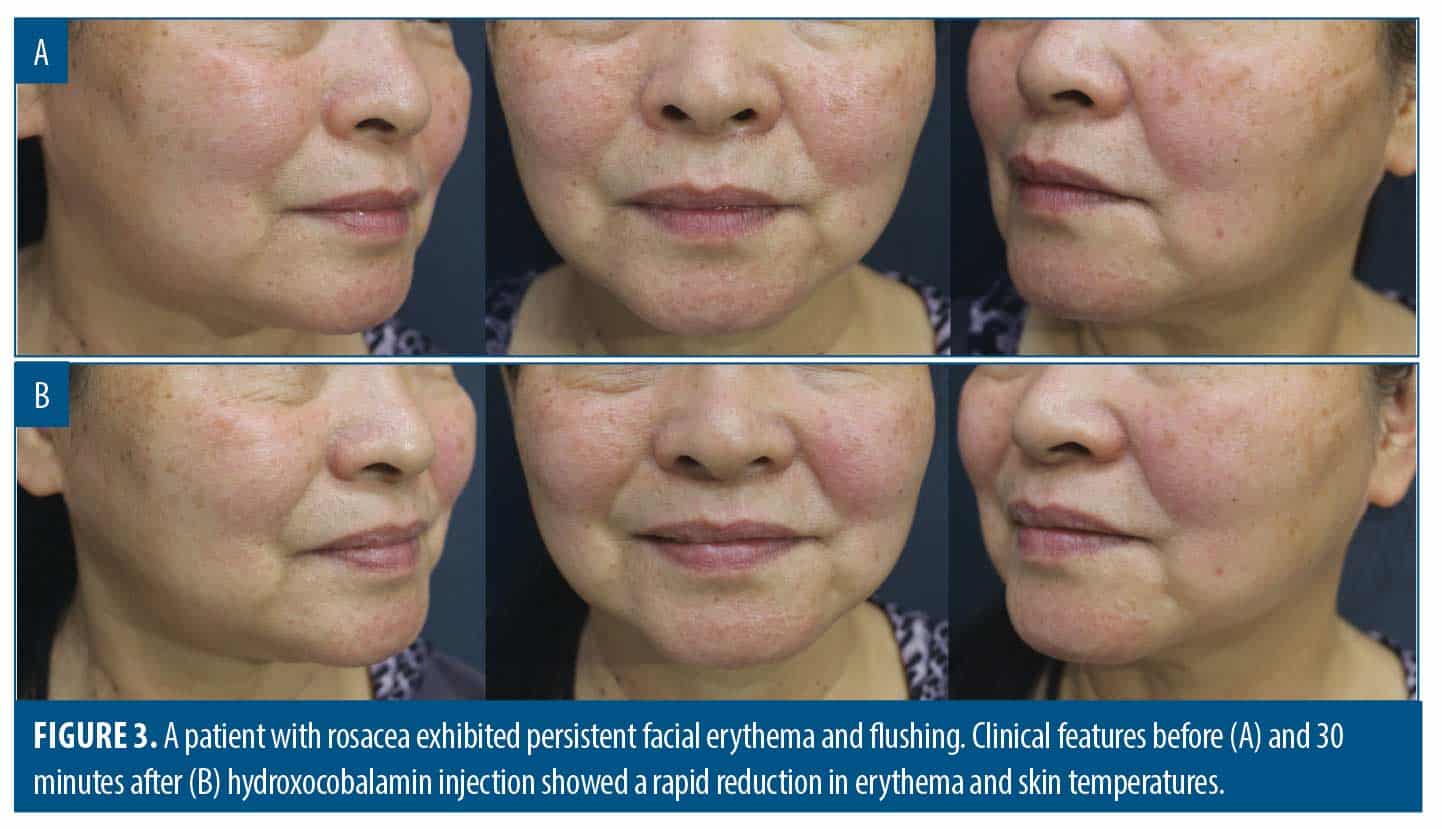 Hydroxocobalamin An Effective Treatment for Flushing and Persistent