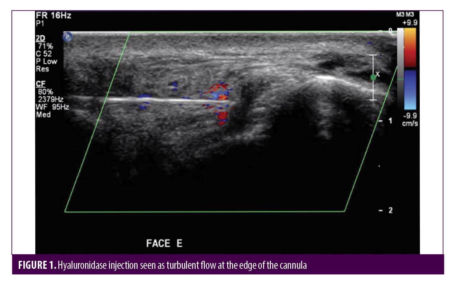 Doppler Ultrasound in the Management of Vascular Complications