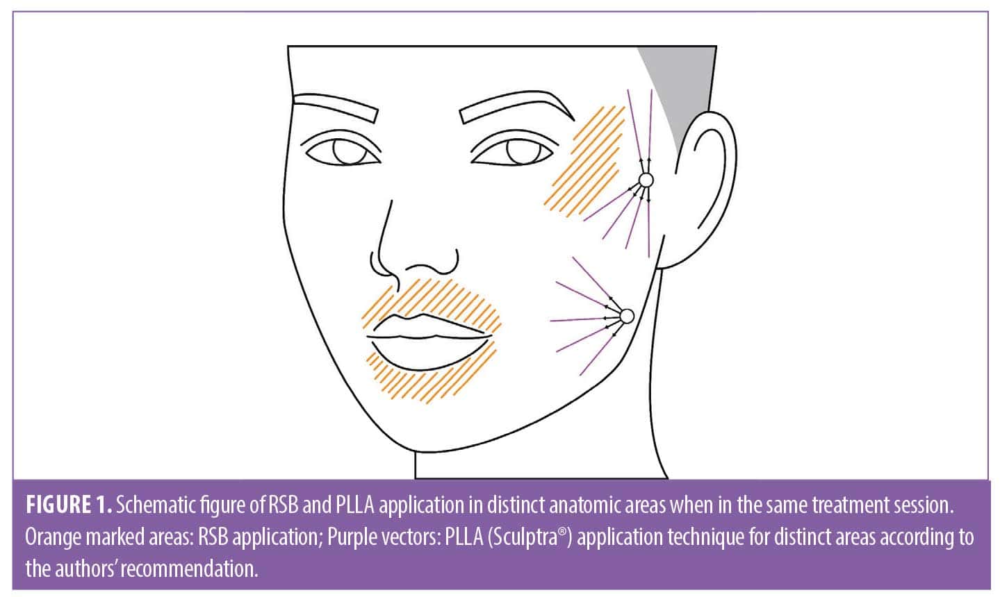 Optimizing Skin Quality with Injectable PolyLLactic Acid and