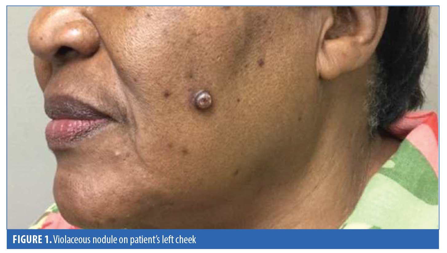 Kaposi of the Face Not Associated with Acquired