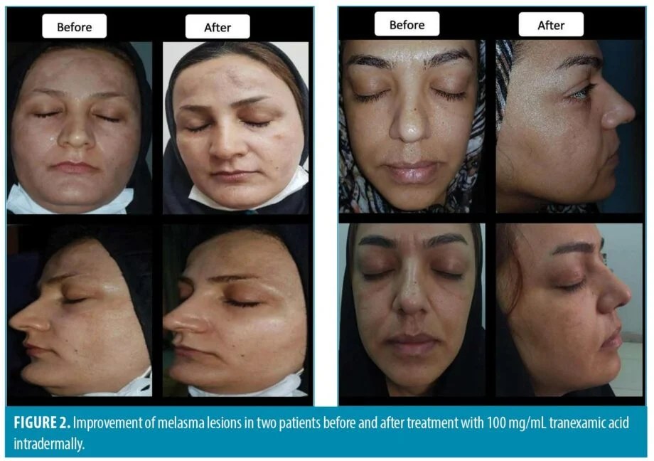 Intradermal Injection of 100mg Tranexamic Acid Versus Topical 4