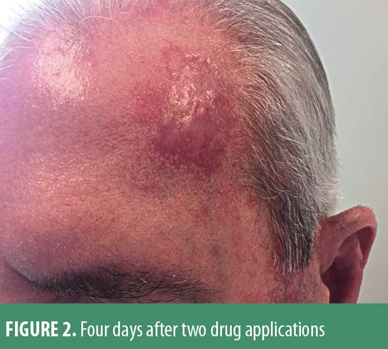 Superficial Basal Cell Carcinoma of the Face Successfully Treated with