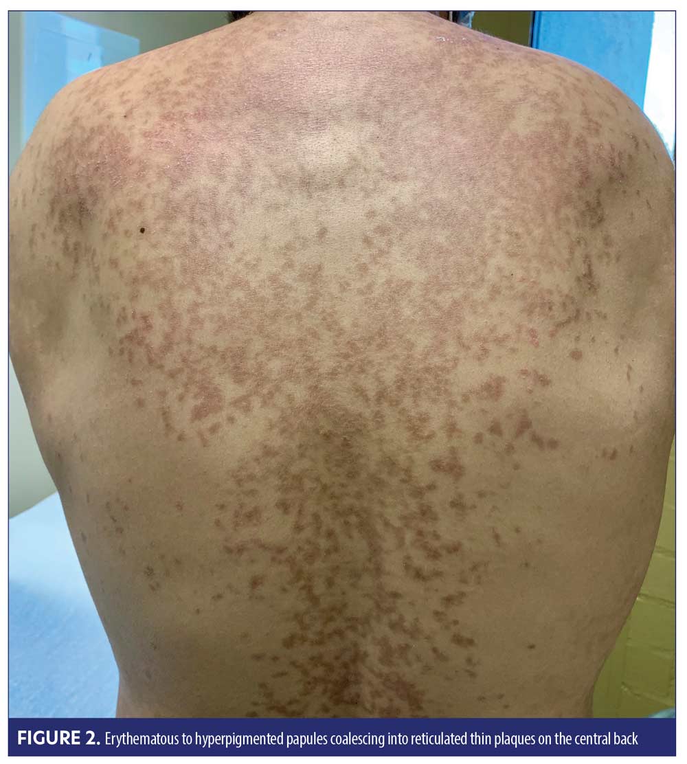 Ketogenic Dietinduced Prurigo Pigmentosa (the “Keto Rash”) A Case