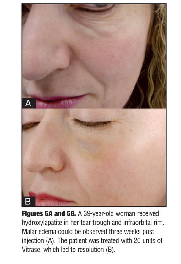 Avoiding Malar Edema During Midface/Cheek Augmentation with Dermal