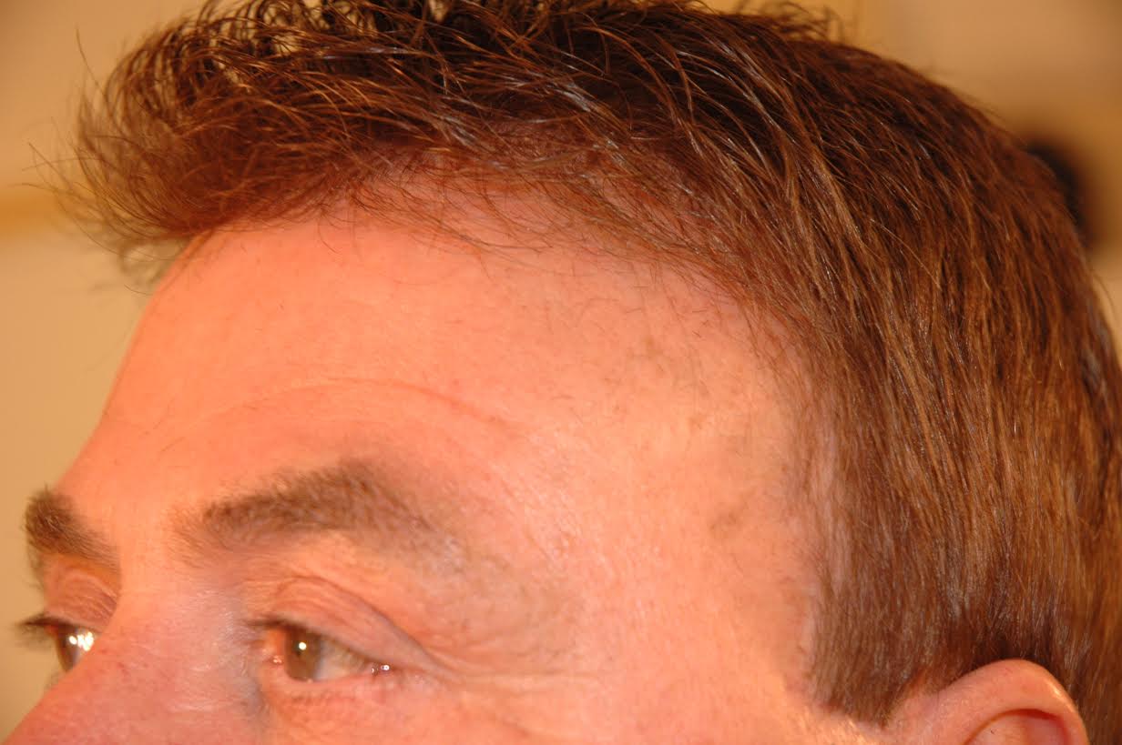 Hair Loss Treatment & Natural Hair Replacement Las Vegas