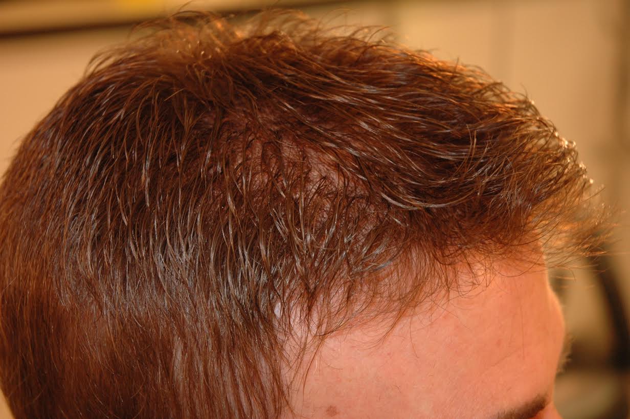 Hair Loss Treatment & Natural Hair Replacement Las Vegas