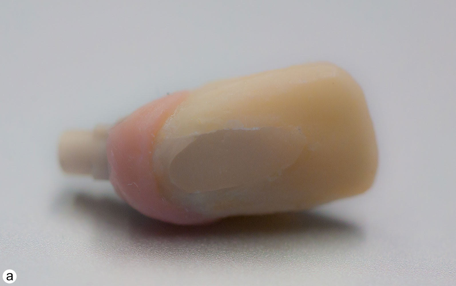 The Use of Pink Porcelain to Manage a Malposed Anterior Implant Case