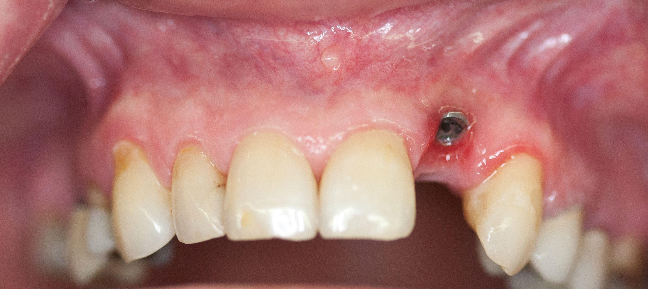 The Use of Pink Porcelain to Manage a Malposed Anterior Implant Case