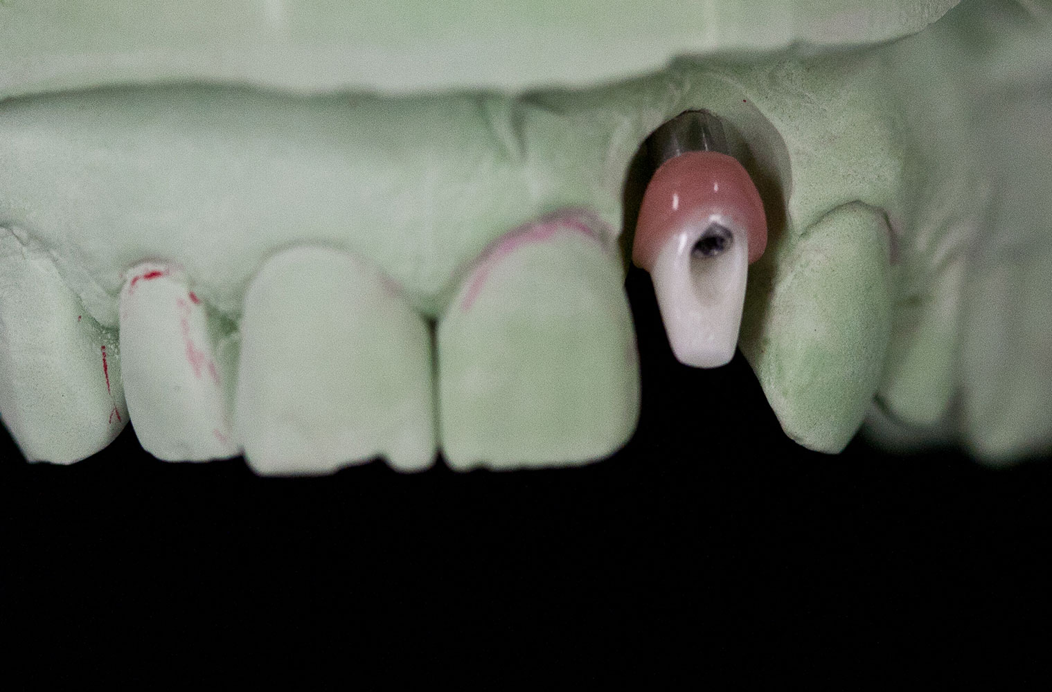 The Use of Pink Porcelain to Manage a Malposed Anterior Implant Case