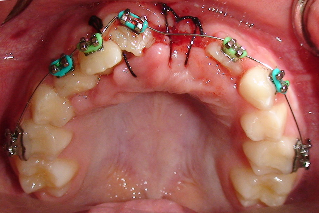 Fixed Orthodontic Appliances in the Management of Severe Dental Trauma