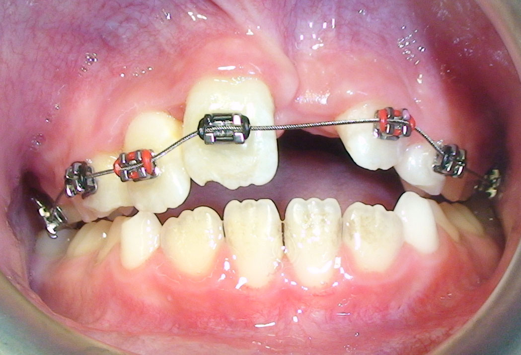 Fixed Orthodontic Appliances in the Management of Severe Dental Trauma