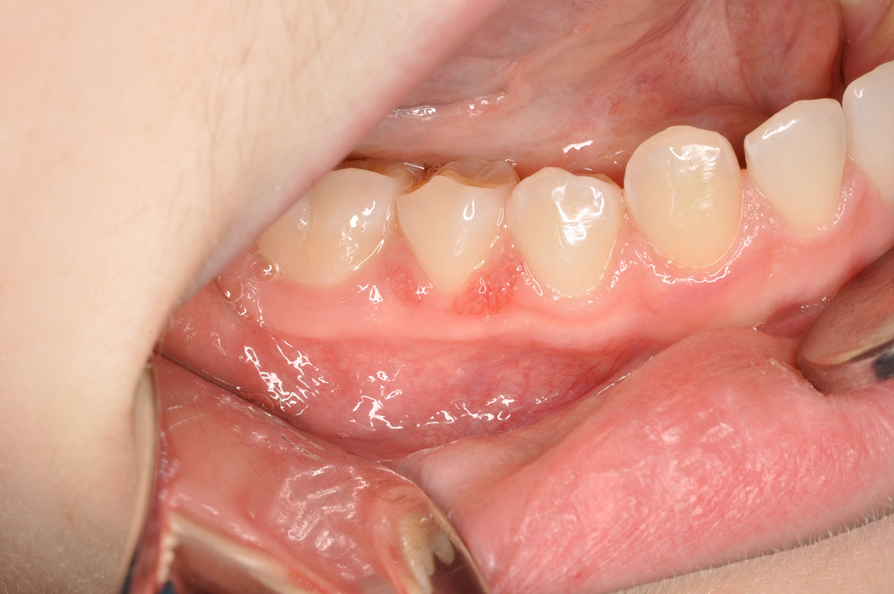 Solitary Gingival Lesion in an Adolescent JCDA