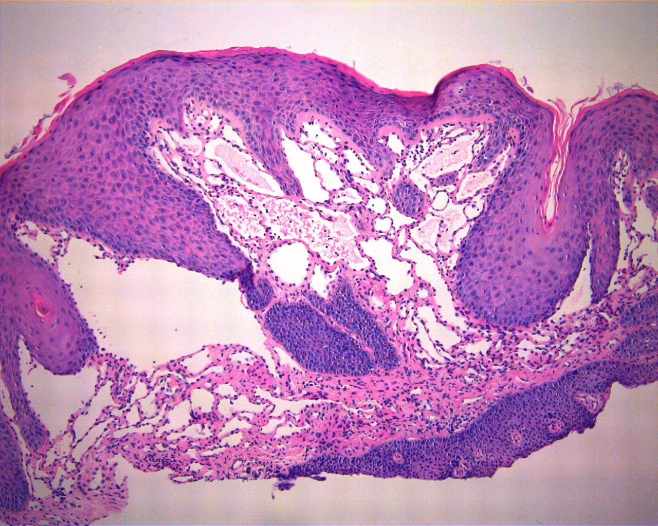Gingival Hyperplasia Histology