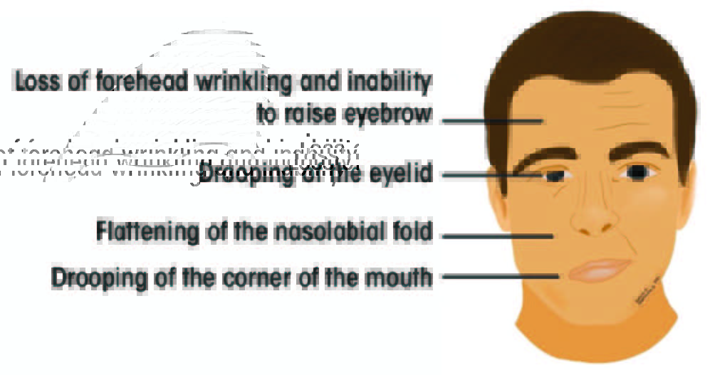 Bell’s Palsy Etiology, Management and Dental Implications jcda