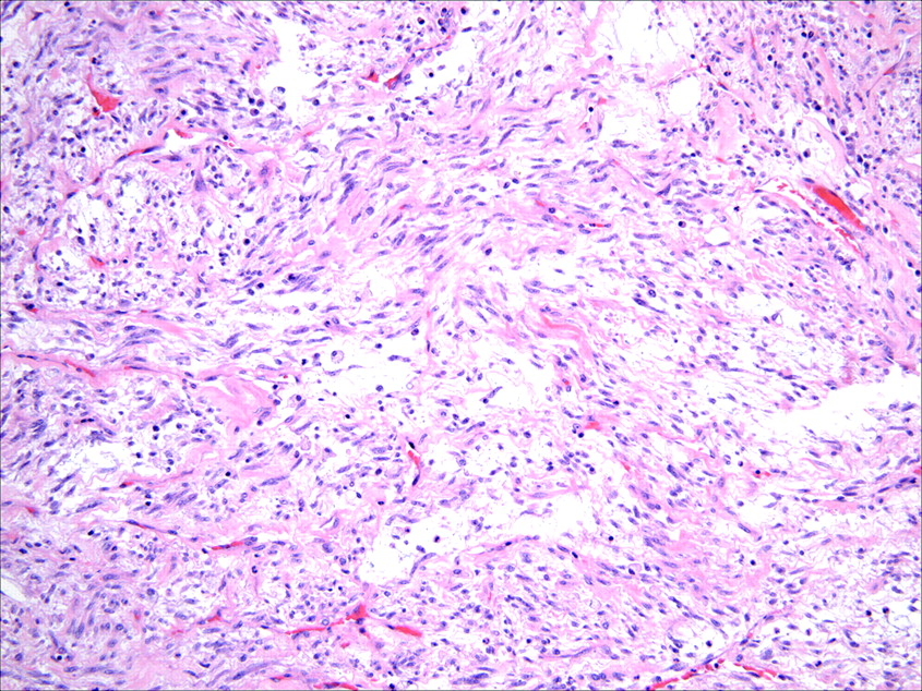 Pathology Outlines Inflammatory myofibroblastic tumor