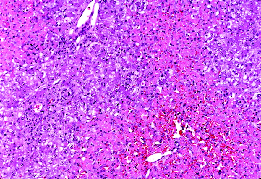 Pathology Outlines Drug / toxin induced hepatitisacetaminophen