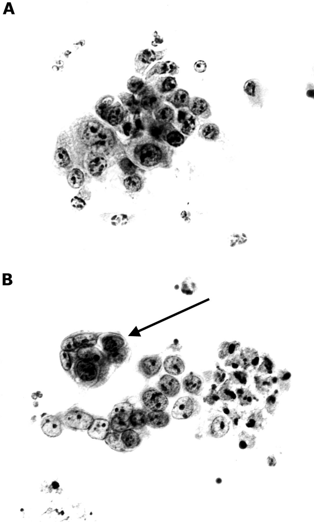 Brush cytology in the assessment of pancreaticobiliary strictures a