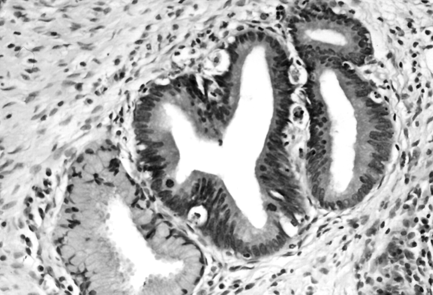 Endocervical glandular lesions controversial aspects and ancillary