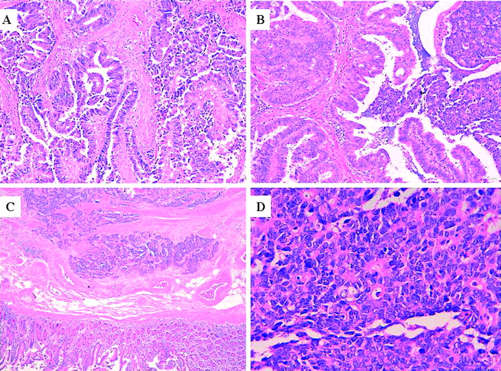 Composite papillary intestinaltype adenocarcinoma/poorly