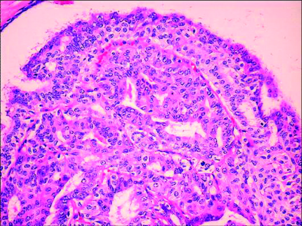 Adenomyoepithelioma of the breast a review stressing its propensity