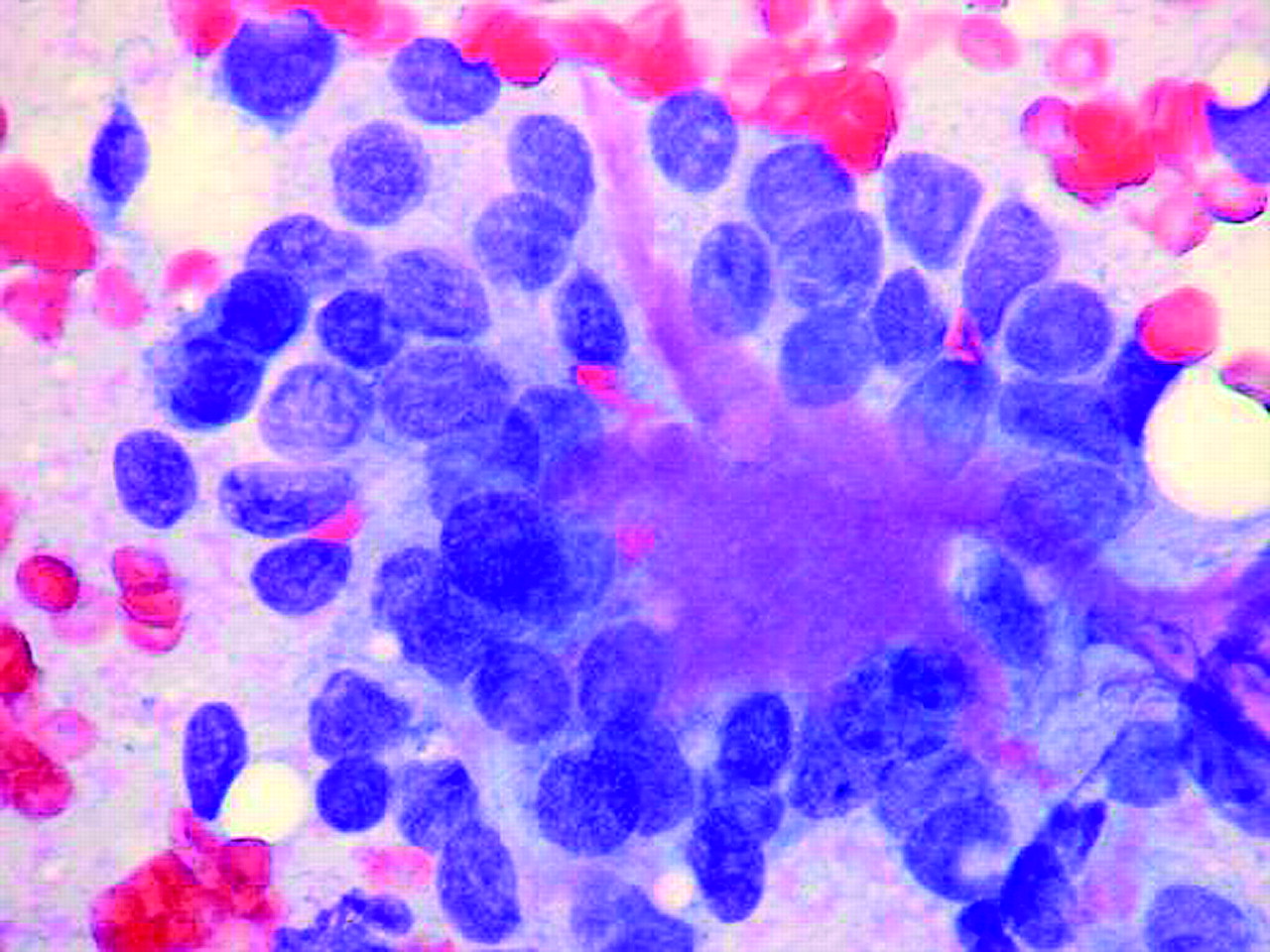 Adenomyoepithelioma of the breast a review stressing its propensity