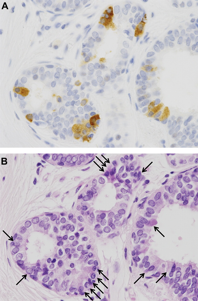 Neuroendocrine cells associated with neuroendocrine carcinoma of the