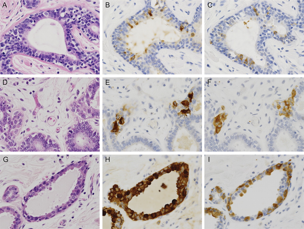 Neuroendocrine cells associated with neuroendocrine carcinoma of the