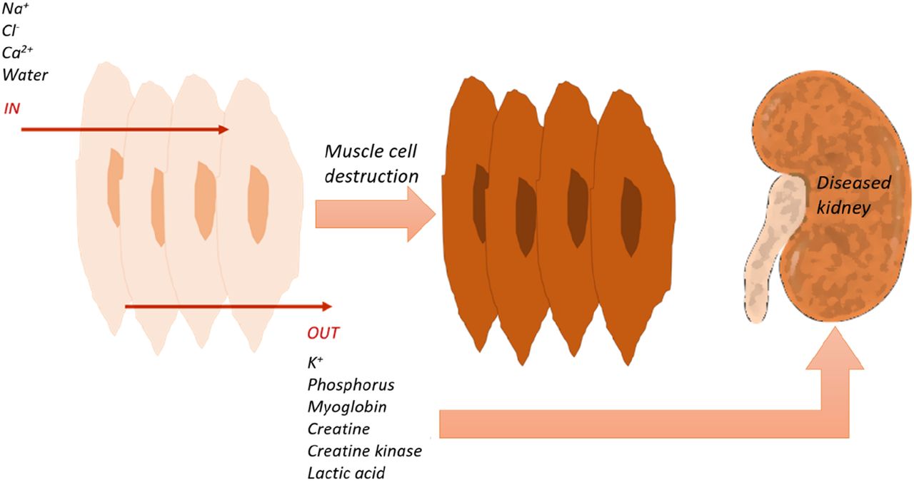 Crush Injury Syndrome Treatment