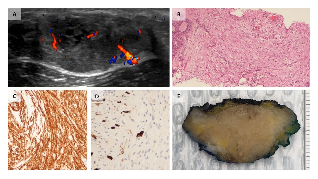 Benign spindle cell lesions of the breast a diagnostic approach to