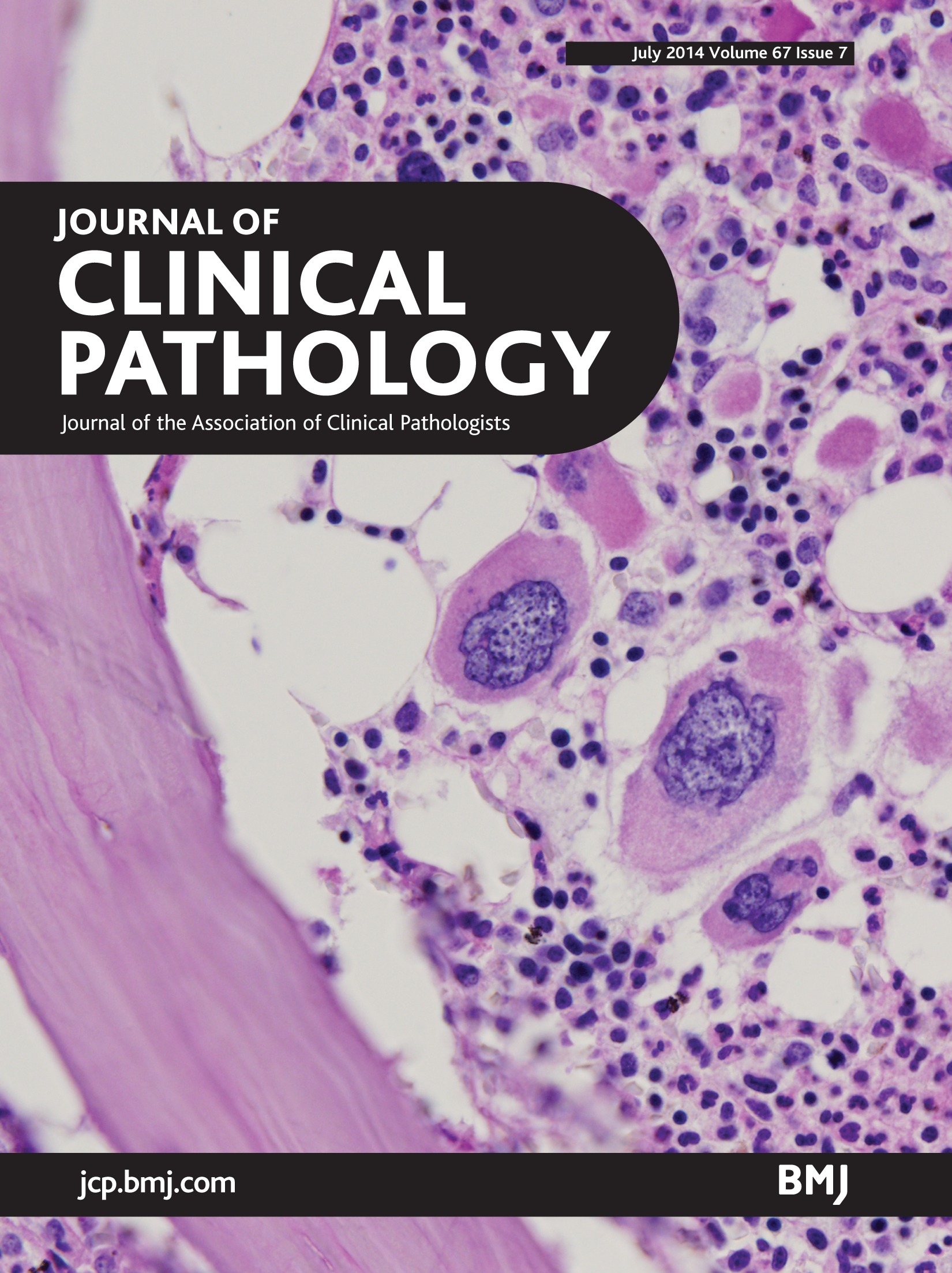 Immature Granulocytes High
