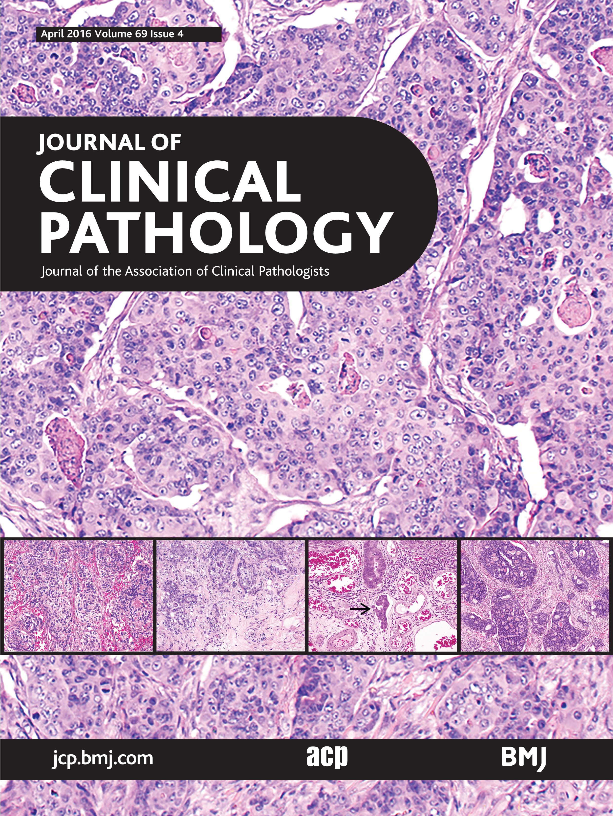 The role of parvovirus B19 in the pathogenesis of autoimmunity and