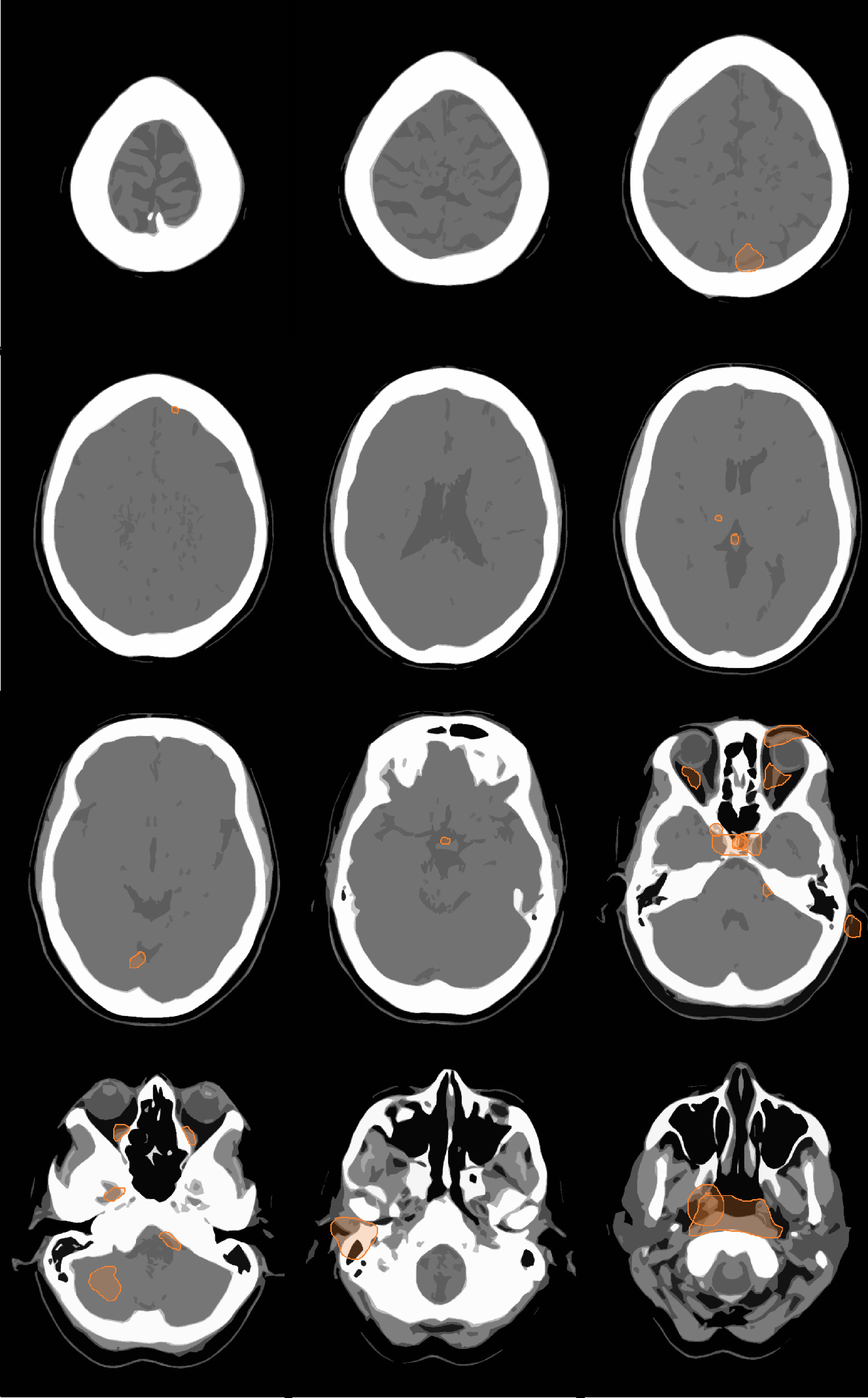 MissMapCT HeadTrauma