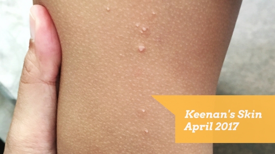 Ada Kutil Pada Anak Mungkin Itu Molluscum Contagiosum