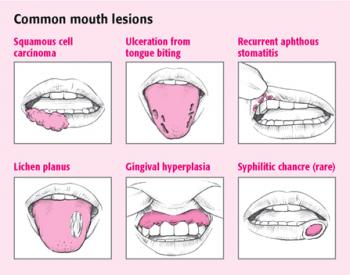 Ajaib, Sariawan Sembuh Dengan Makanan dan Minuman Ini – Jernih.co