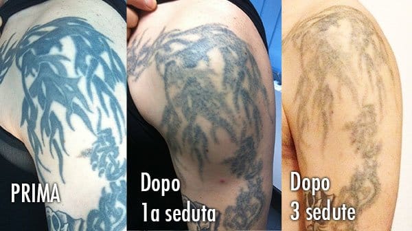 Coperture E Rimozioni – Jerry Magni Tatuatore Bergamo 336_x_600_jpg