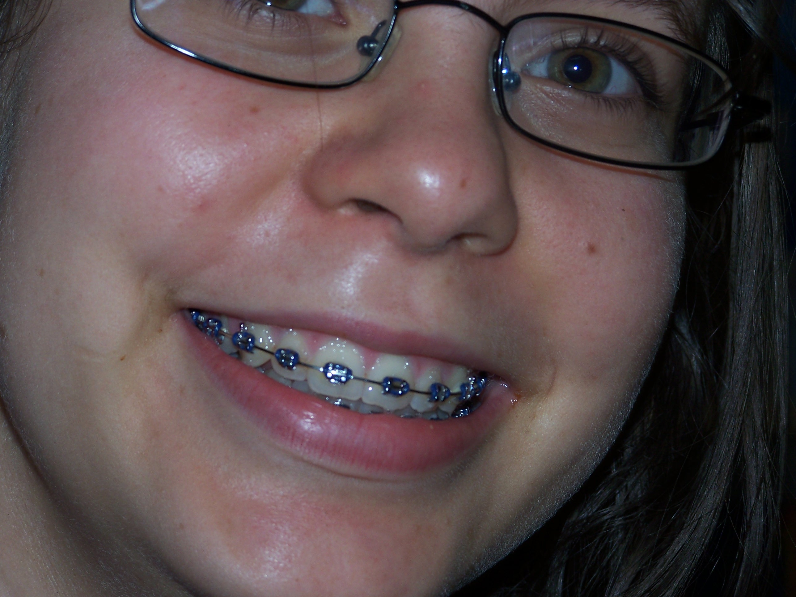 With braces