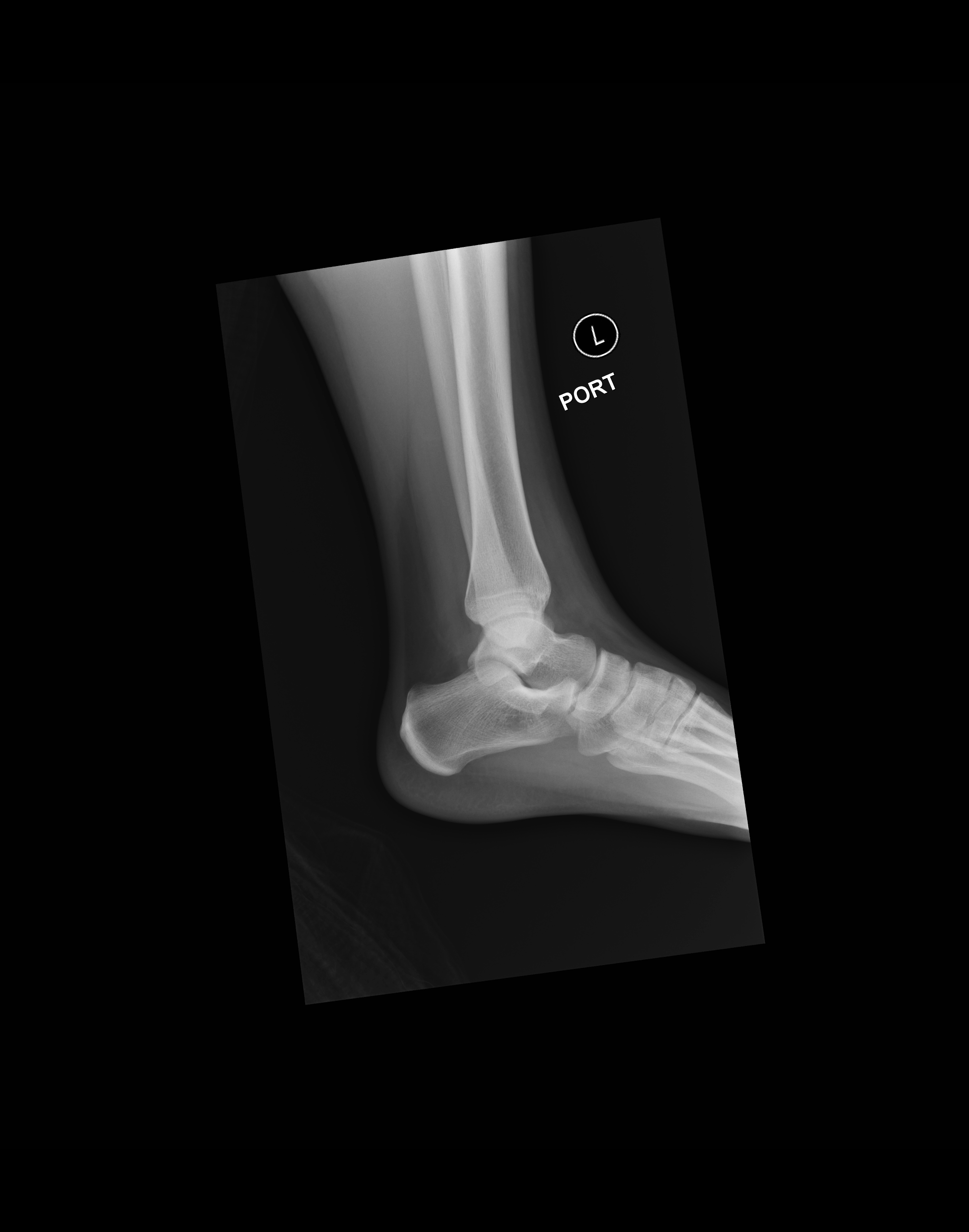 Calcaneal Fractures and Böhler’s Angle JETem