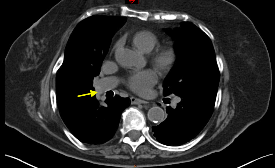 What Is A Ct Scan With Contrast For Chest