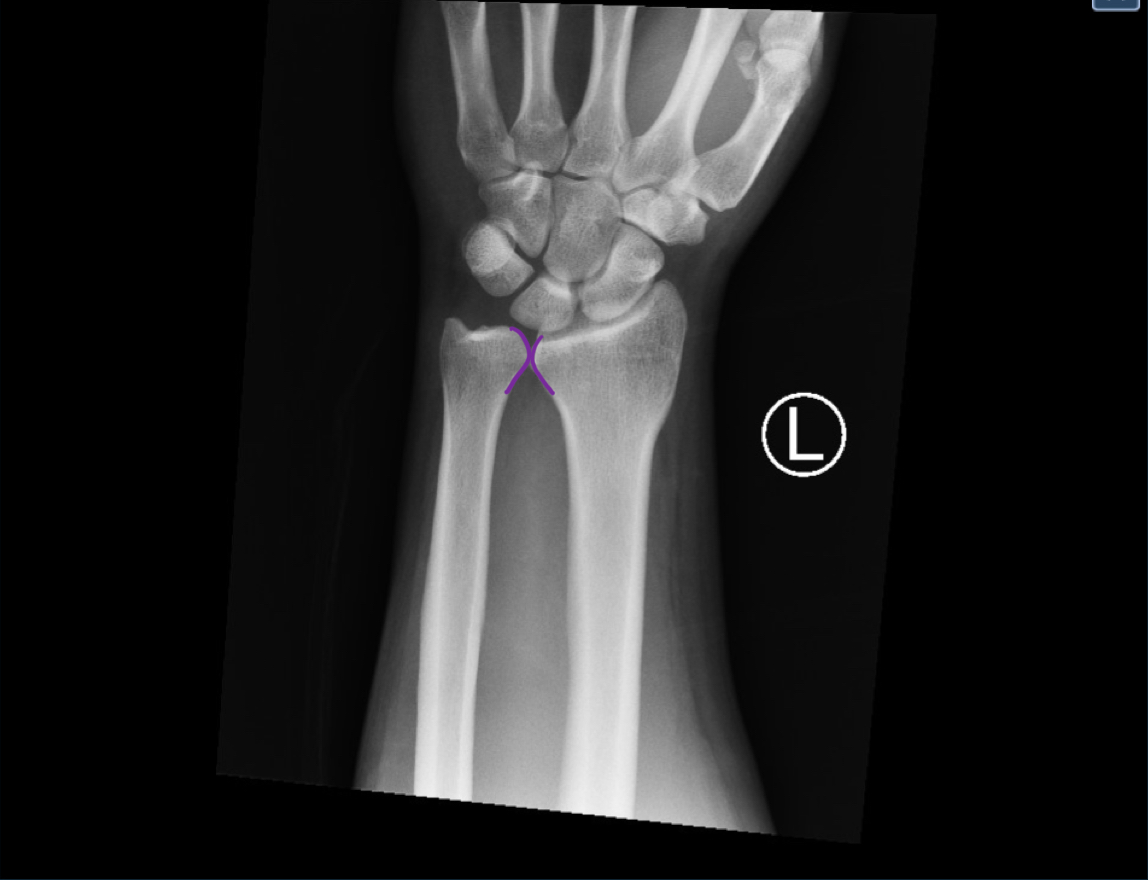 DRUJ Wrist Xray, AP, Annotated. JETem 2020 JETem