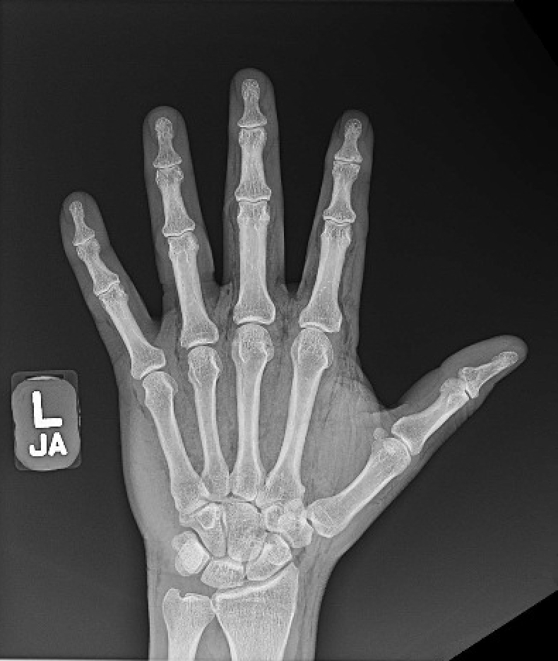 HighPressure Injection Injury to the Hand A Case Report JETem