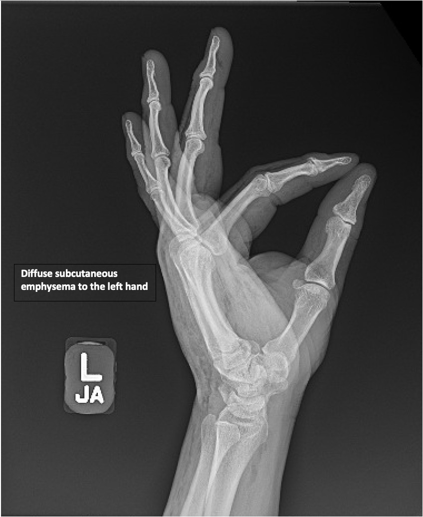 HighPressure Injection Injury to the Hand A Case Report JETem