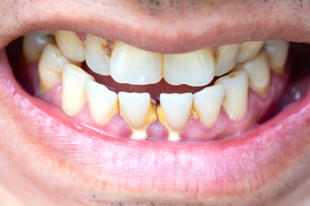 Cálculos dentales Causas, síntomas y factores de riesgo Doctor Jhon
