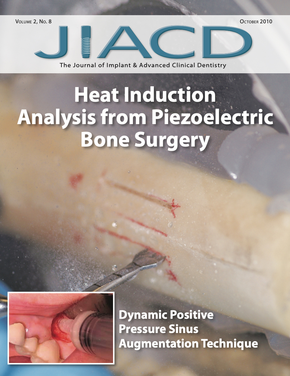 Heat Induction Analysis from Piezoelectric Bone Surgery — JIACD JIACD