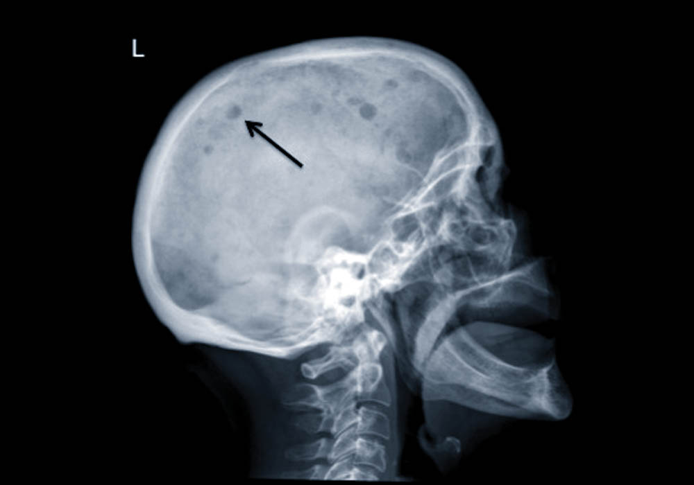 Multiple myeloma presenting as mandibular pain Journal